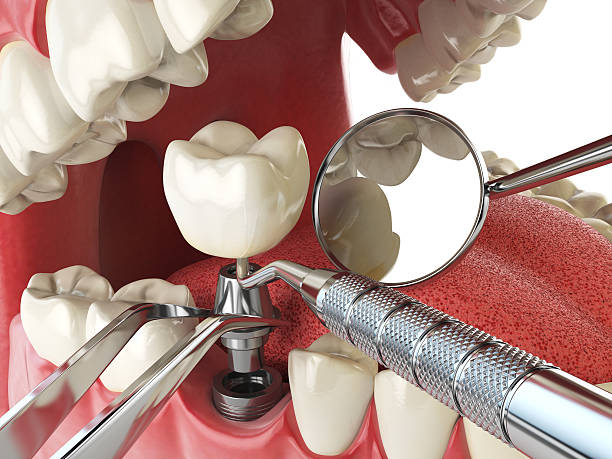 Best Emergency Treatment for Dental Infections or Abscesses in Dunlap, OH